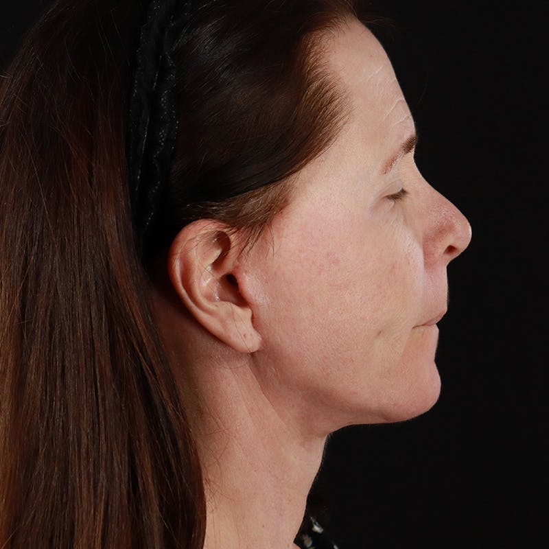 Facelift Before & After Gallery - Patient 114497 - Image 6