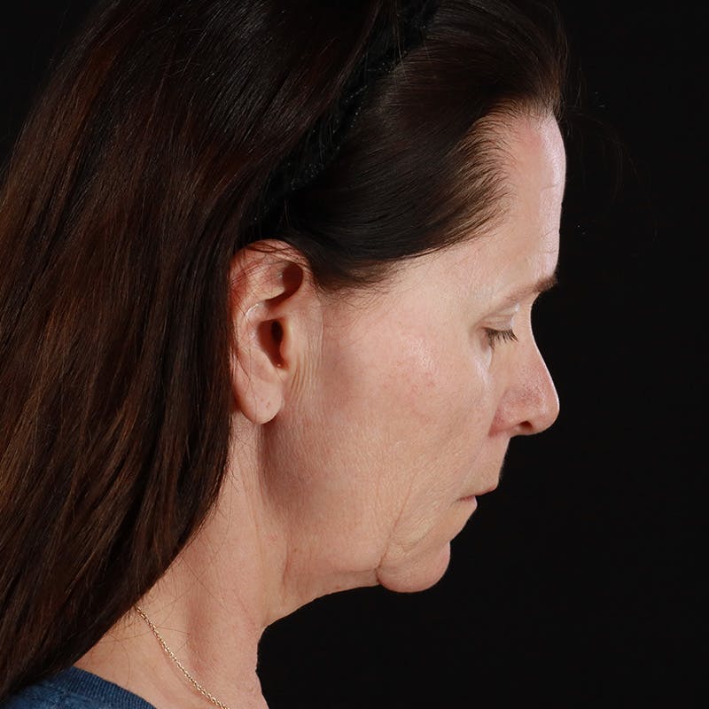 Neck Lift Before & After Gallery - Patient 365782 - Image 11
