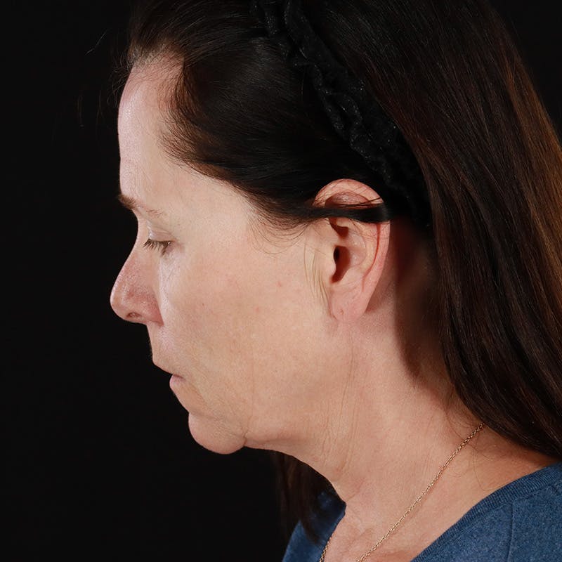 Neck Lift Before & After Gallery - Patient 365782 - Image 3