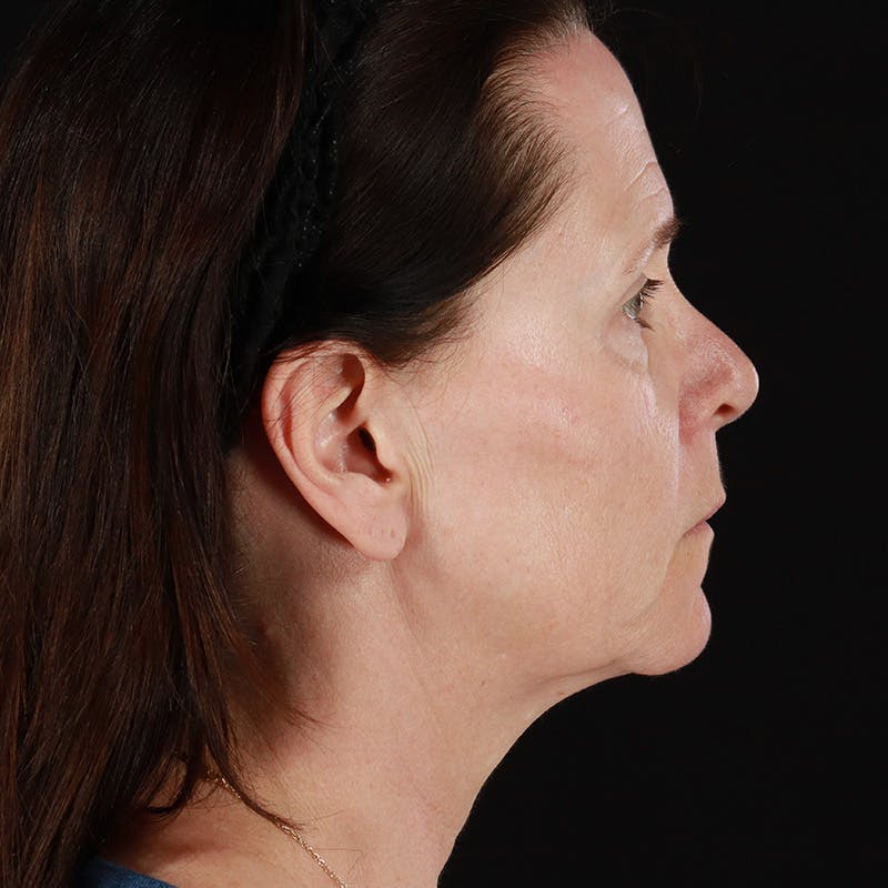Facelift Before & After Gallery - Patient 114497 - Image 5