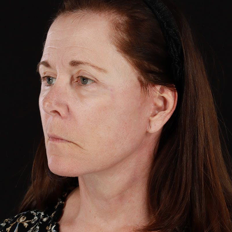 Facelift Before & After Gallery - Patient 114497 - Image 10