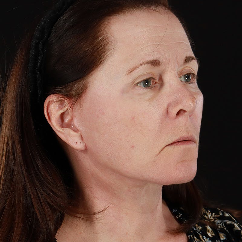 Facelift Before & After Gallery - Patient 114497 - Image 4