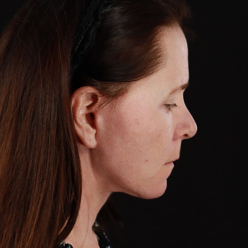 Facelift Before & After Gallery - Patient 114497 - Image 8