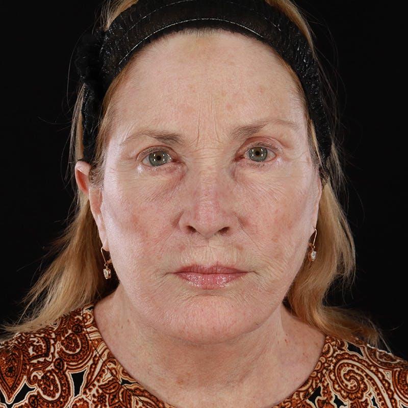 Neck Lift Before & After Gallery - Patient 302175 - Image 4