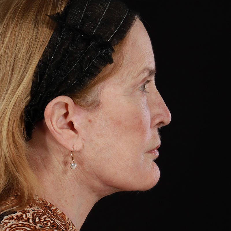 Facelift Before & After Gallery - Patient 343720 - Image 6