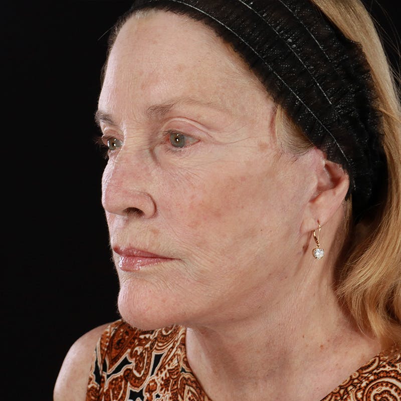 Facelift Before & After Gallery - Patient 343720 - Image 8