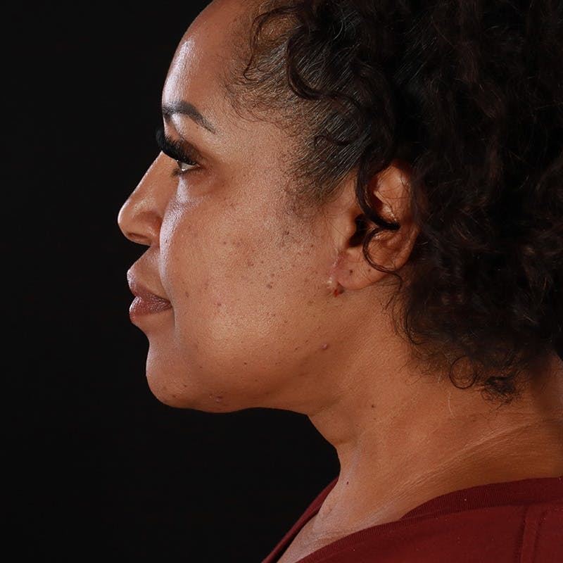 Neck Lift Before & After Gallery - Patient 804795 - Image 2