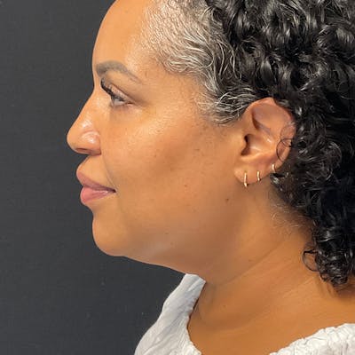 Neck Lift Before & After Gallery - Patient 804795 - Image 1