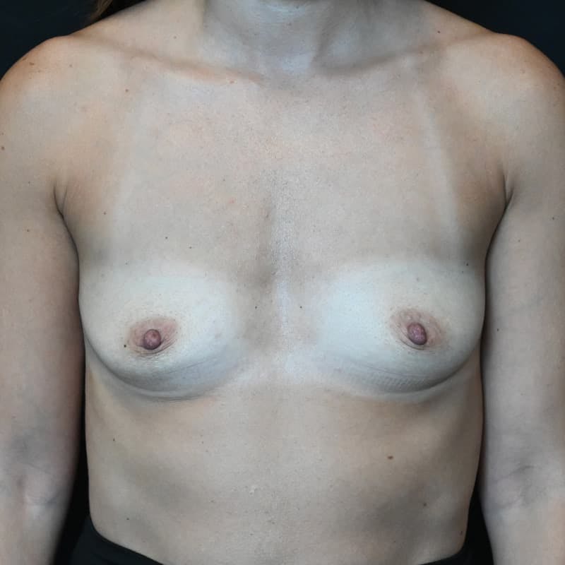 Breast Augmentation Before & After Gallery - Patient 146709 - Image 1