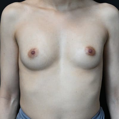 Breast Augmentation Before & After Gallery - Patient 326534 - Image 1