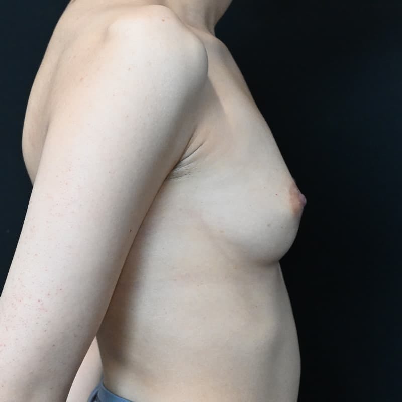 Breast Augmentation Before & After Gallery - Patient 326534 - Image 11