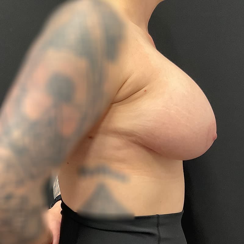Breast Augmentation with Lift Before & After Gallery - Patient 613838 - Image 8