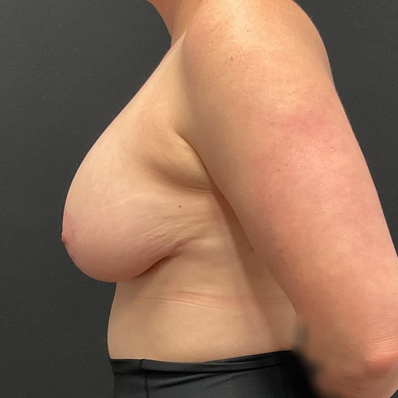 Breast Augmentation with Lift Before & After Gallery - Patient 613838 - Image 12