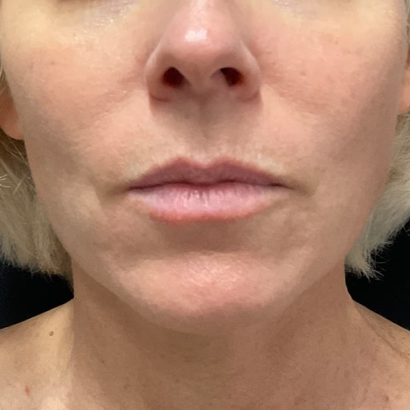 Lip Lift Before & After Gallery - Patient 351661 - Image 1