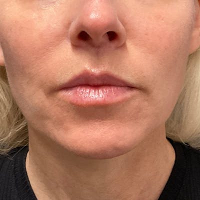 Lip Lift Before & After Gallery - Patient 351661 - Image 2