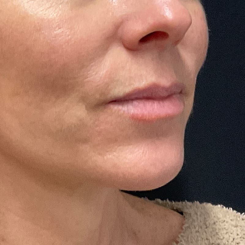 Lip Lift Before & After Gallery - Patient 351661 - Image 3