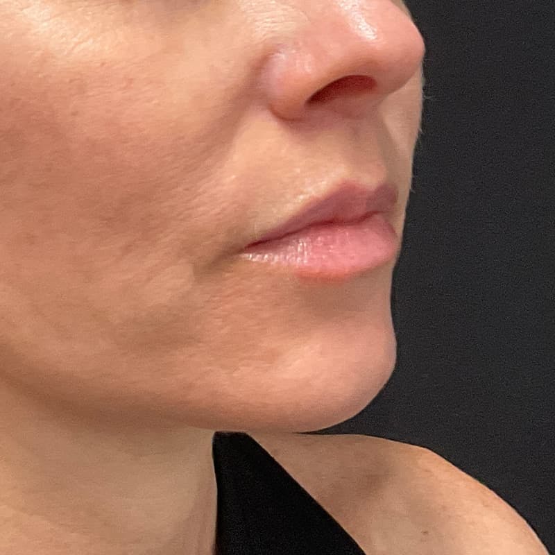 Lip Lift Before & After Gallery - Patient 351661 - Image 4