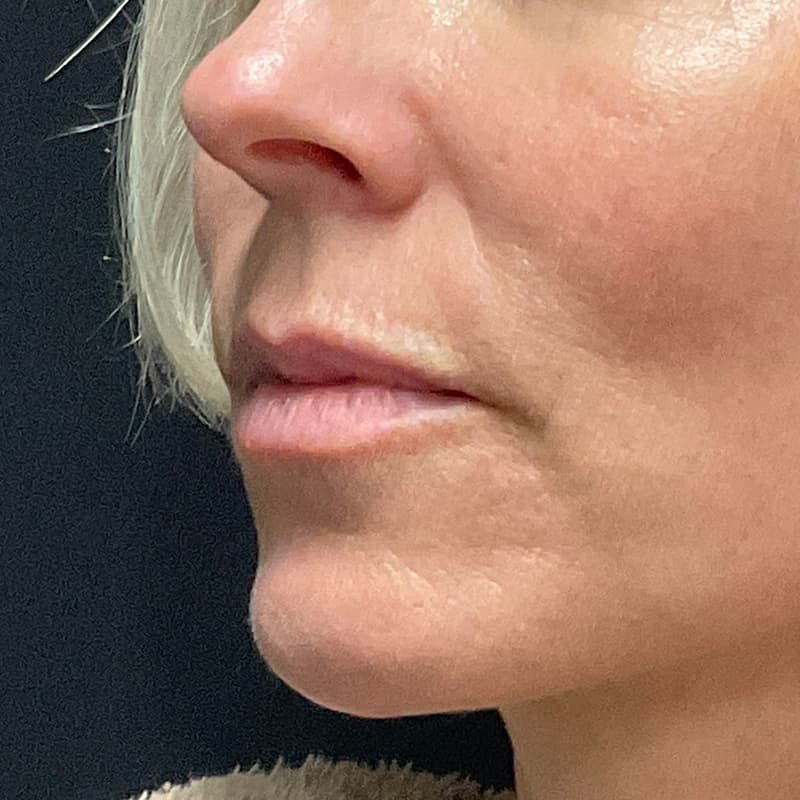 Lip Lift Before & After Gallery - Patient 351661 - Image 5