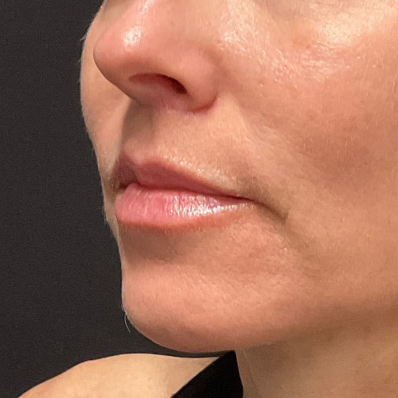 Lip Lift Before & After Gallery - Patient 351661 - Image 6