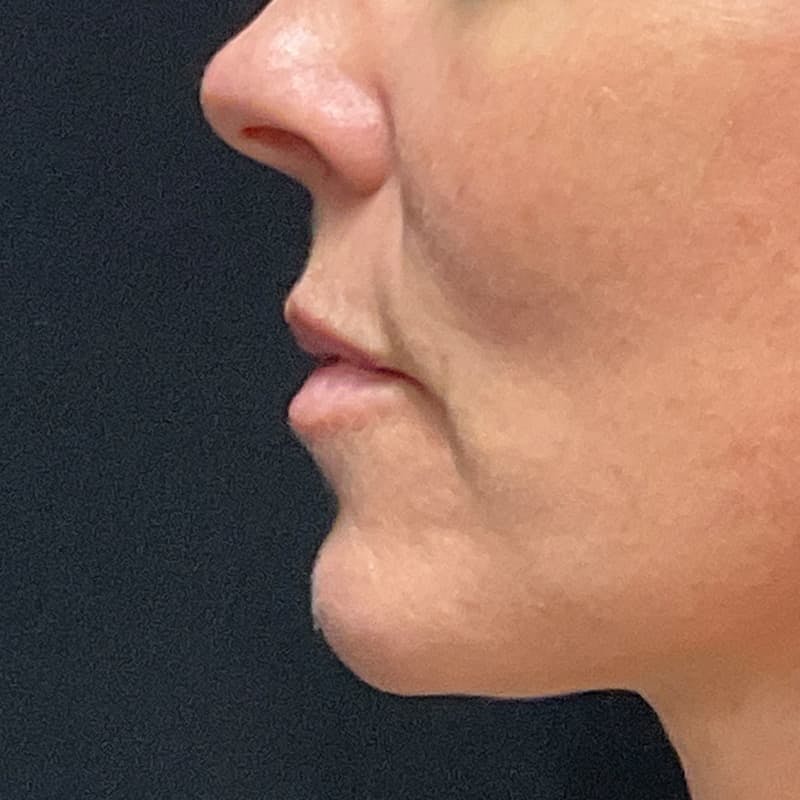 Lip Lift Before & After Gallery - Patient 351661 - Image 7