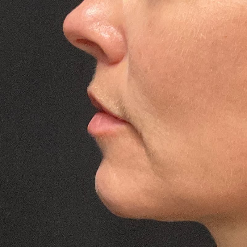 Lip Lift Before & After Gallery - Patient 351661 - Image 8