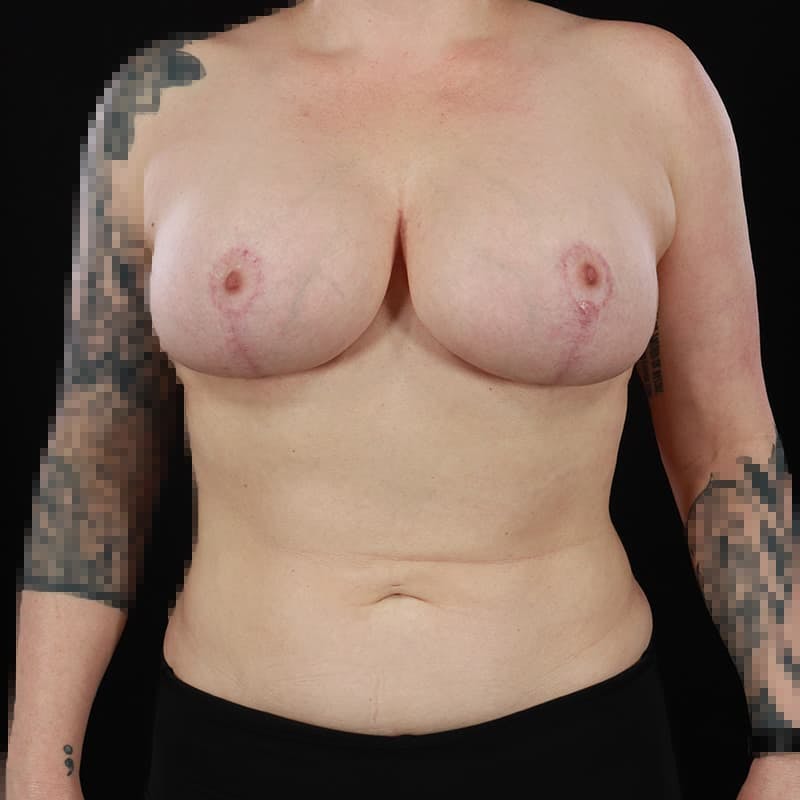 Liposuction Before & After Gallery - Patient 300579 - Image 4