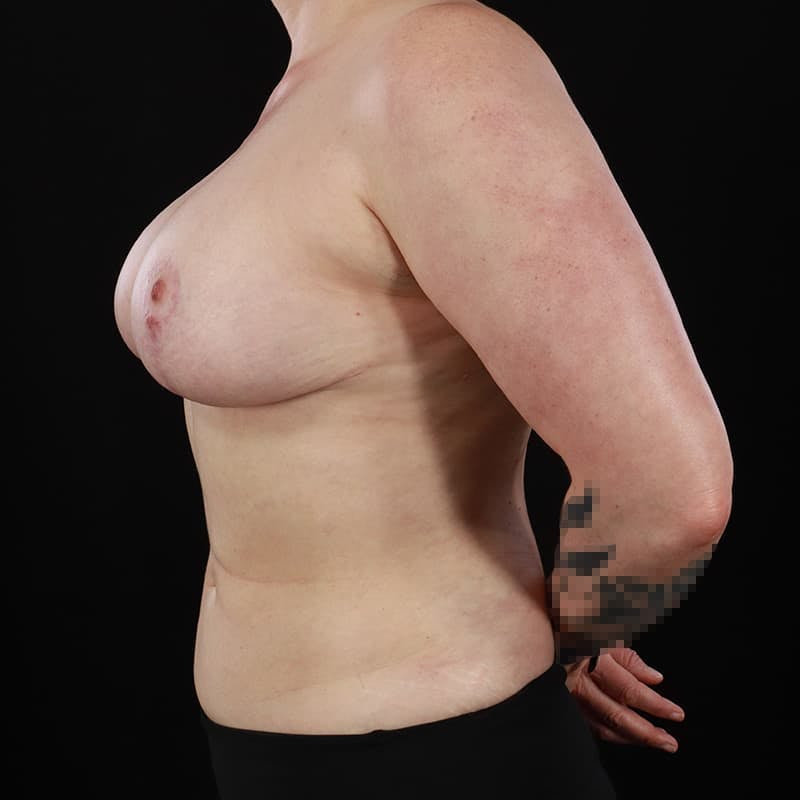 Liposuction Before & After Gallery - Patient 300579 - Image 6