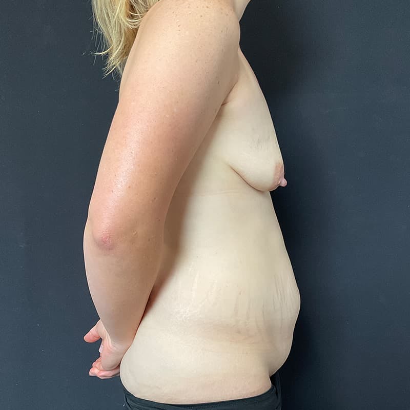 Abdominoplasty (Tummy Tuck) Before & After Gallery - Patient 402480 - Image 5