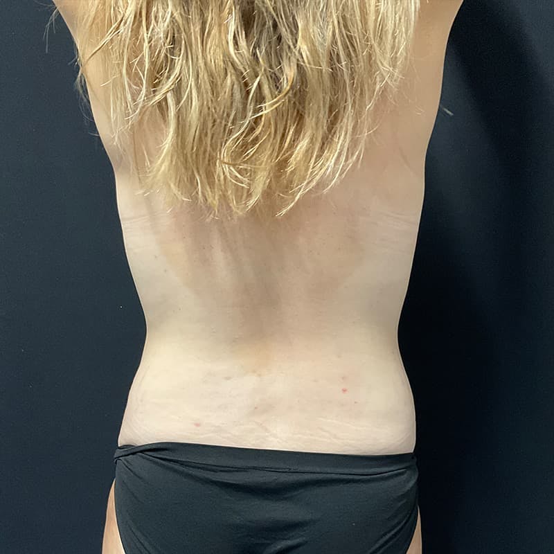 Abdominoplasty (Tummy Tuck) Before & After Gallery - Patient 402480 - Image 14