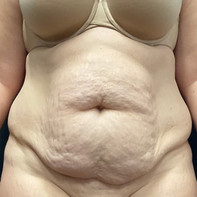 Abdominoplasty (Tummy Tuck) Before & After Gallery - Patient 134561 - Image 1
