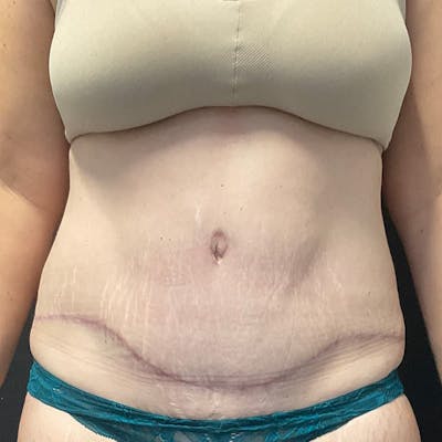 Abdominoplasty (Tummy Tuck) Before & After Gallery - Patient 134561 - Image 2