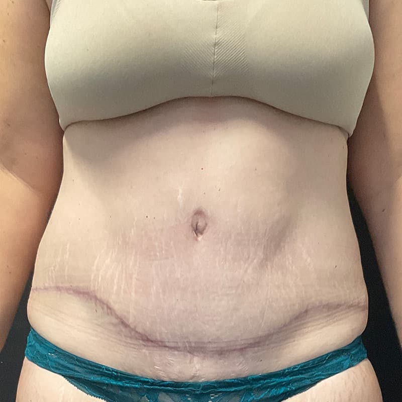 Abdominoplasty (Tummy Tuck) Before & After Gallery - Patient 134561 - Image 2