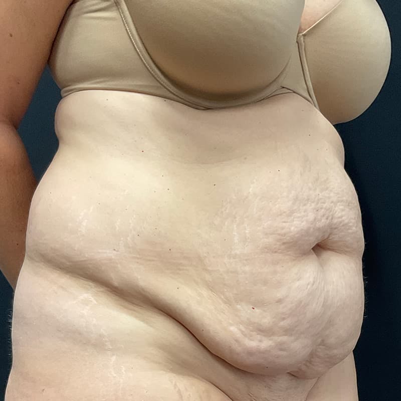 Abdominoplasty (Tummy Tuck) Before & After Gallery - Patient 134561 - Image 3