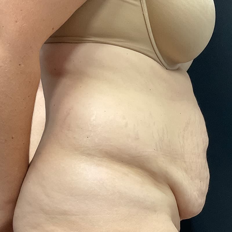 Abdominoplasty (Tummy Tuck) Before & After Gallery - Patient 134561 - Image 5