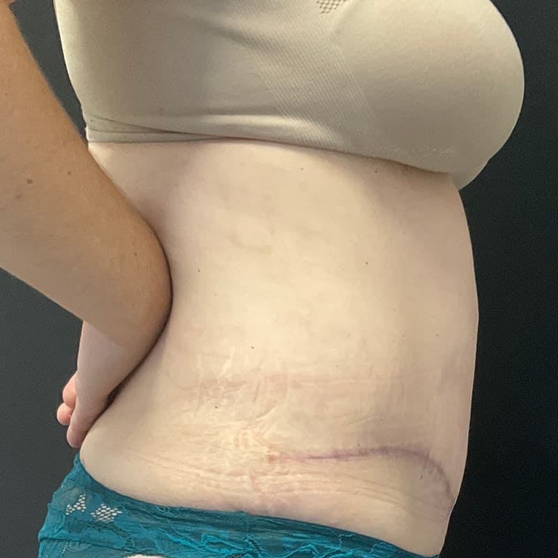 Abdominoplasty (Tummy Tuck) Before & After Gallery - Patient 134561 - Image 6
