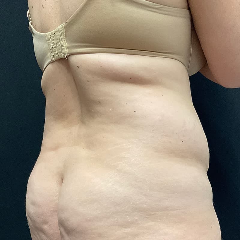 Abdominoplasty (Tummy Tuck) Before & After Gallery - Patient 134561 - Image 7