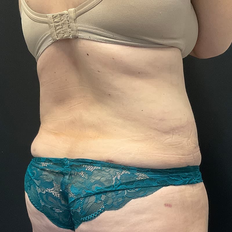 Abdominoplasty (Tummy Tuck) Before & After Gallery - Patient 134561 - Image 8