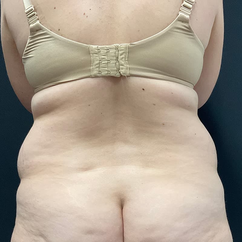 Abdominoplasty (Tummy Tuck) Before & After Gallery - Patient 134561 - Image 9