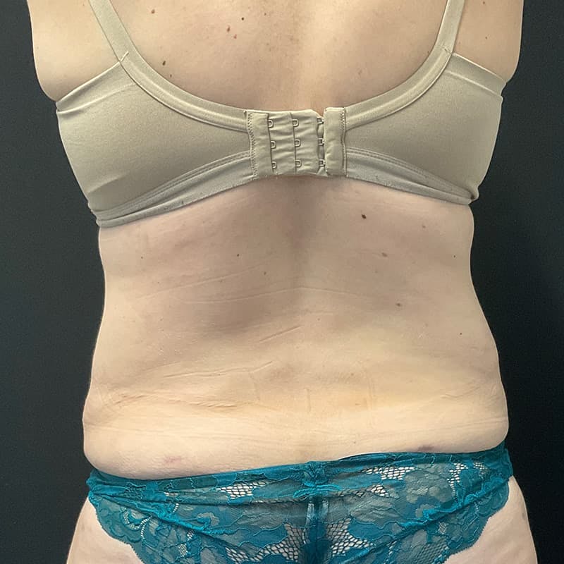 Abdominoplasty (Tummy Tuck) Before & After Gallery - Patient 134561 - Image 10