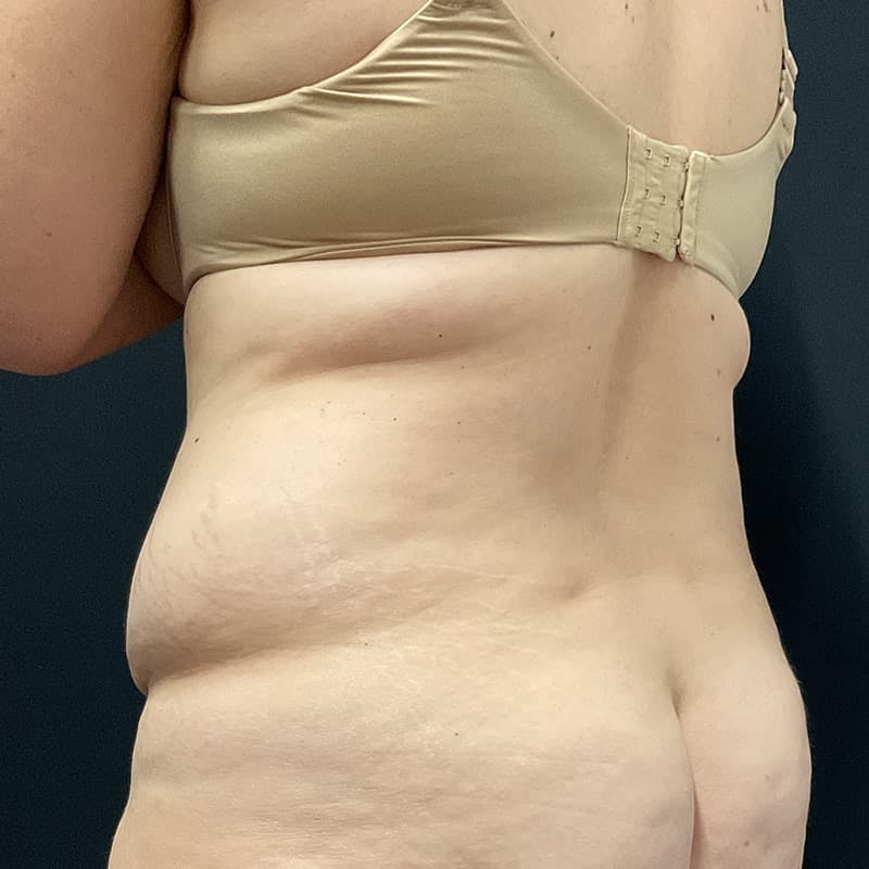Abdominoplasty (Tummy Tuck) Before & After Gallery - Patient 134561 - Image 11