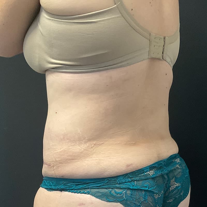 Abdominoplasty (Tummy Tuck) Before & After Gallery - Patient 134561 - Image 12