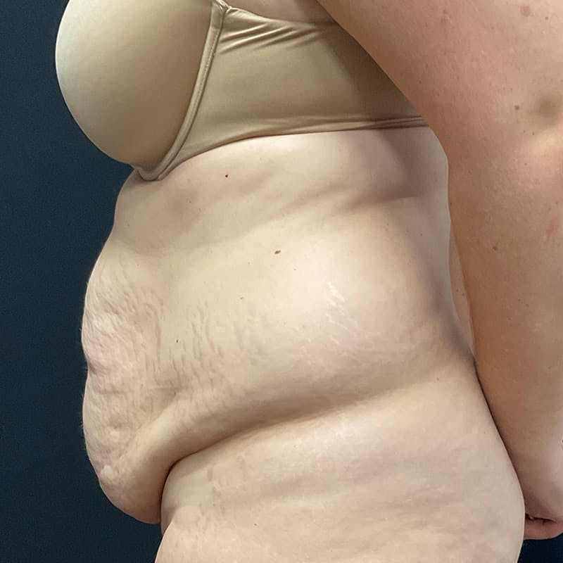 Abdominoplasty (Tummy Tuck) Before & After Gallery - Patient 134561 - Image 13