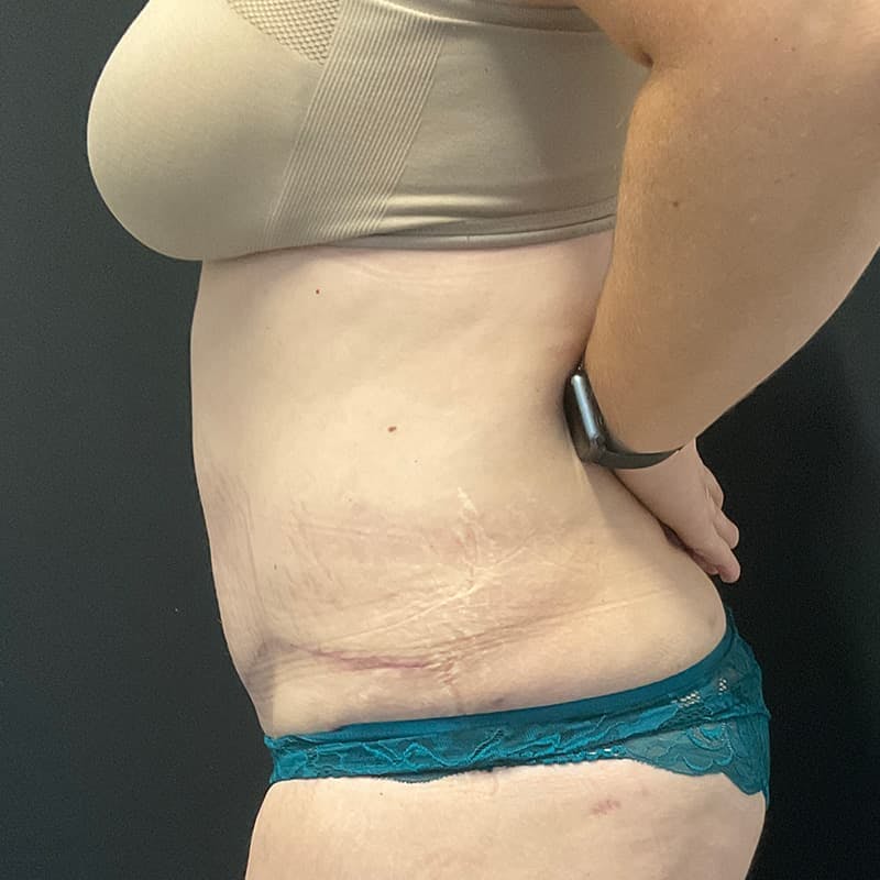 Abdominoplasty (Tummy Tuck) Before & After Gallery - Patient 134561 - Image 14
