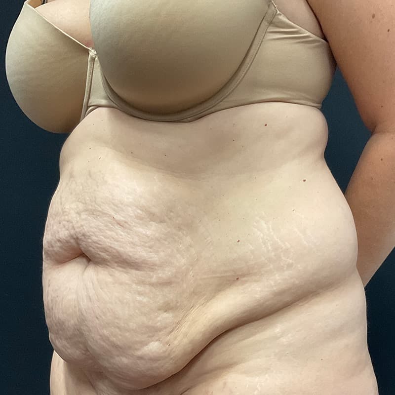 Abdominoplasty (Tummy Tuck) Before & After Gallery - Patient 134561 - Image 15