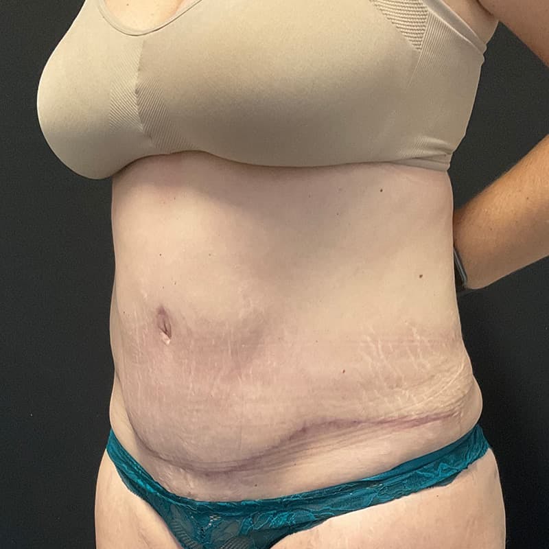 Abdominoplasty (Tummy Tuck) Before & After Gallery - Patient 134561 - Image 16