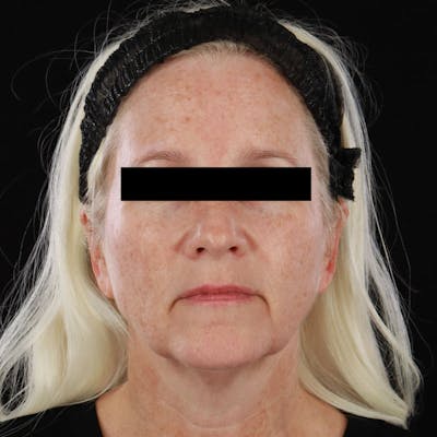 BroadBand Light™ Therapy Before & After Gallery - Patient 621119 - Image 1
