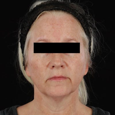 BroadBand Light™ Therapy Before & After Gallery - Patient 621119 - Image 2