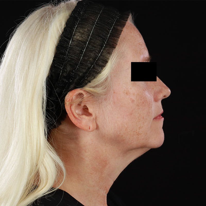 BroadBand Light™ Therapy Before & After Gallery - Patient 621119 - Image 3