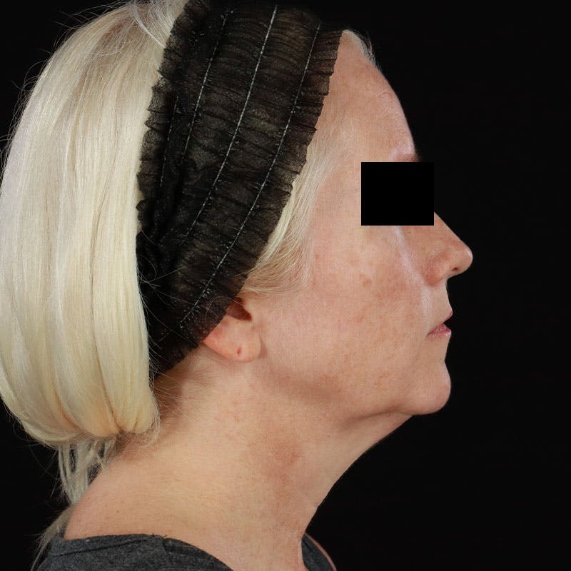 BroadBand Light™ Therapy Before & After Gallery - Patient 621119 - Image 4
