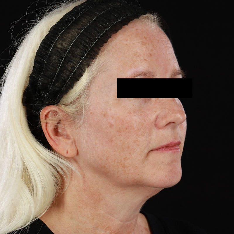 BroadBand Light™ Therapy Before & After Gallery - Patient 621119 - Image 5